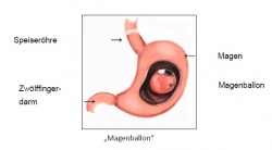 Magenballon